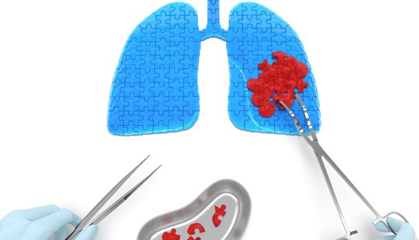 肺裡有結節!需要馬上開刀摘掉嗎?